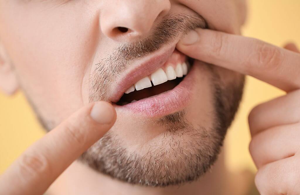 10 Signs That Your Headaches May Be Caused by Wisdom Teeth - Smiles By
